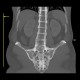 Ankylosing spondylitis, Bechterew's disease, Crohn's disease: CT - Computed tomography